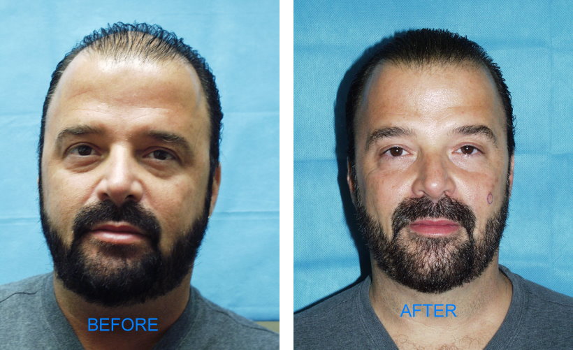 Follicular Unit Hair Transplants (Before & After)